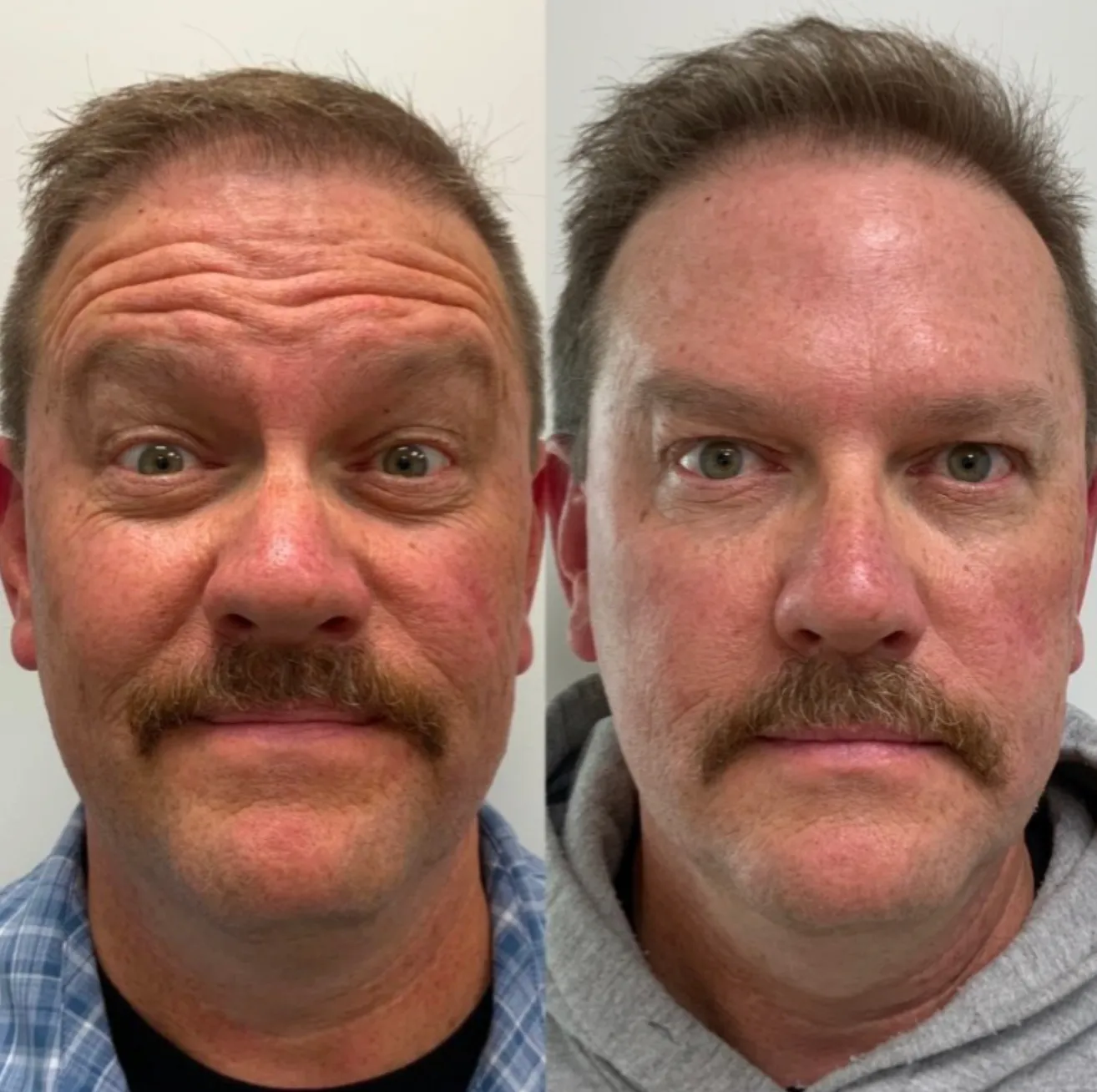 Botox before and after results 1