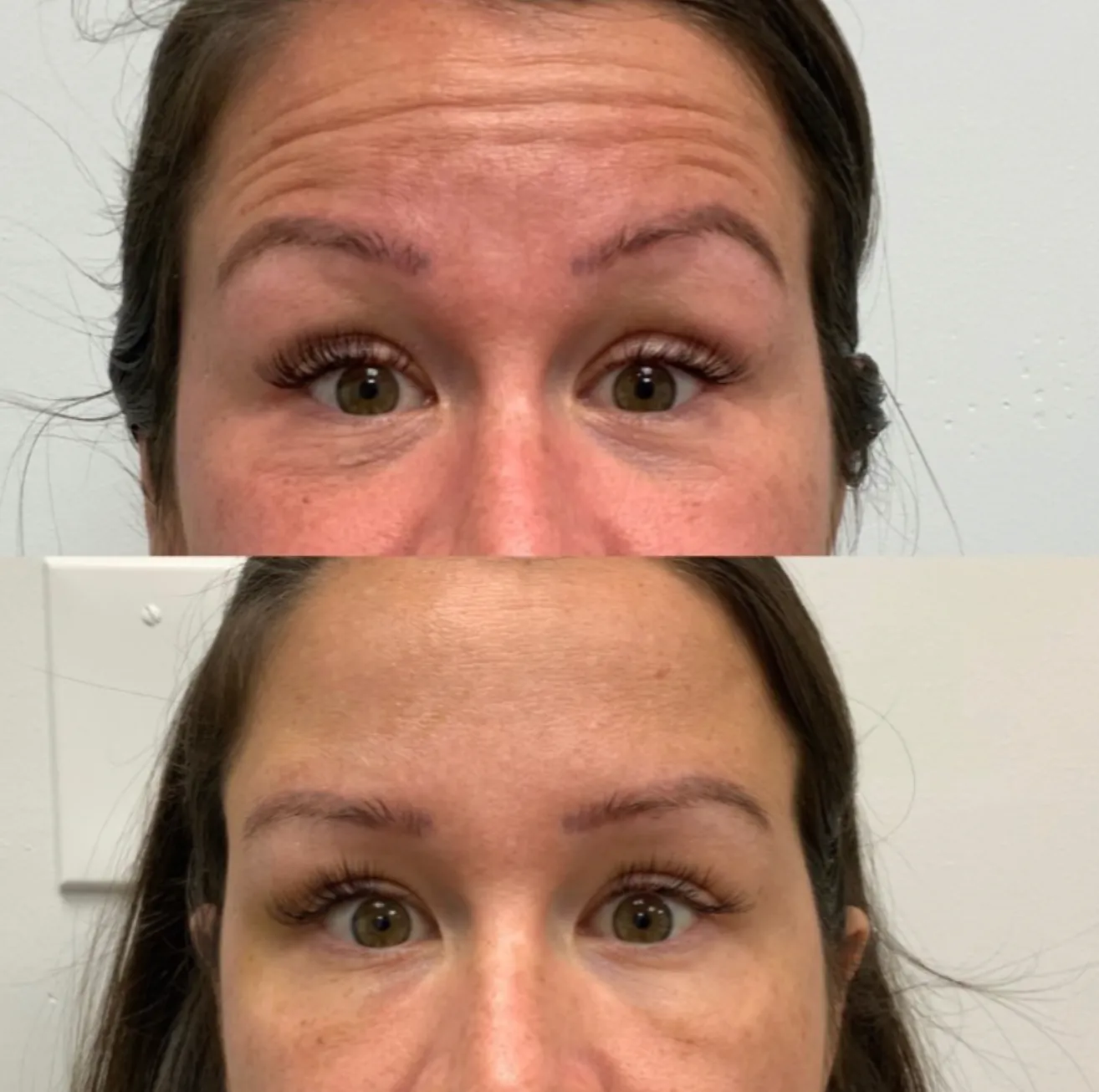 Botox before and after results 2