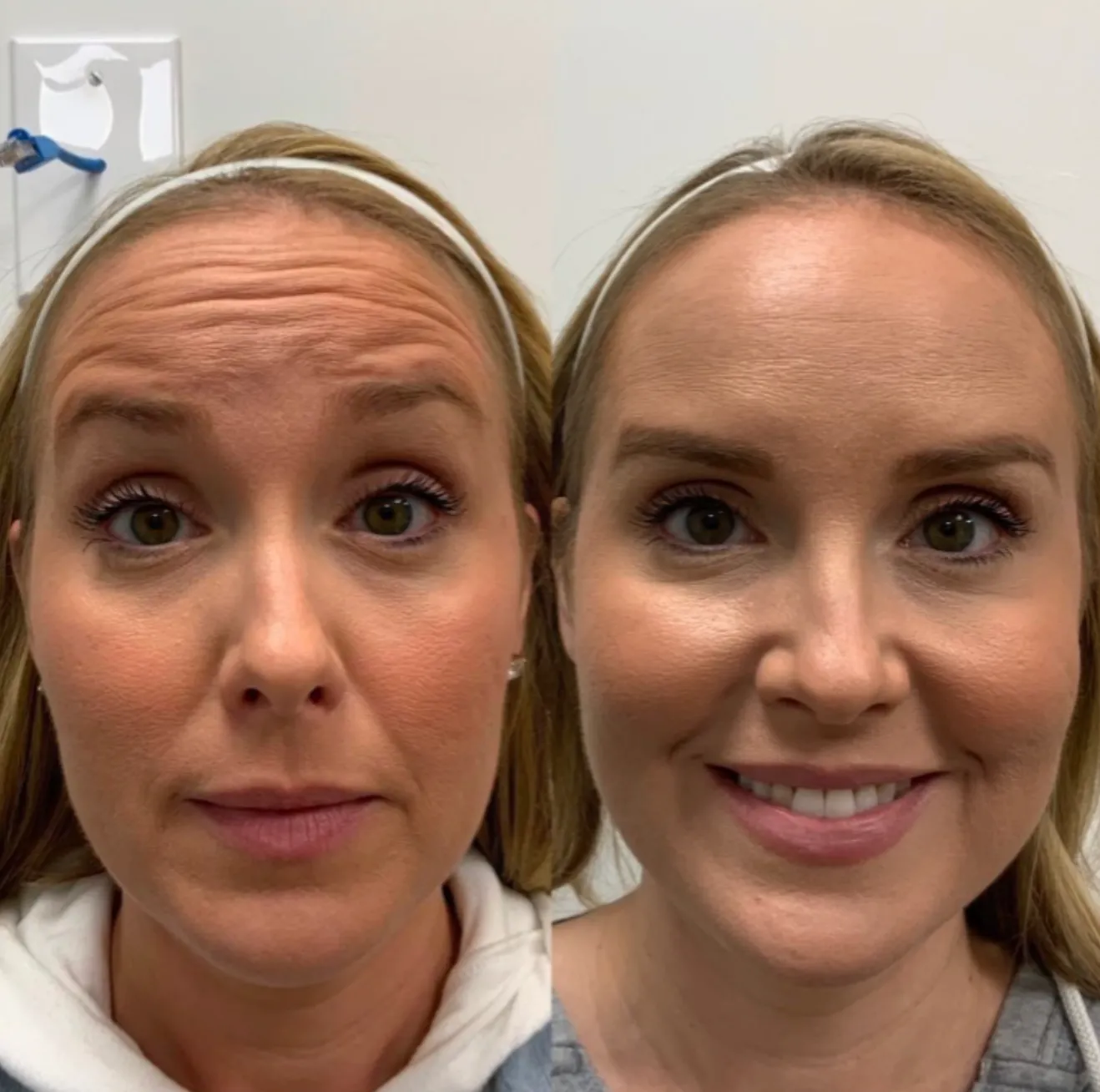 Botox before and after results 3