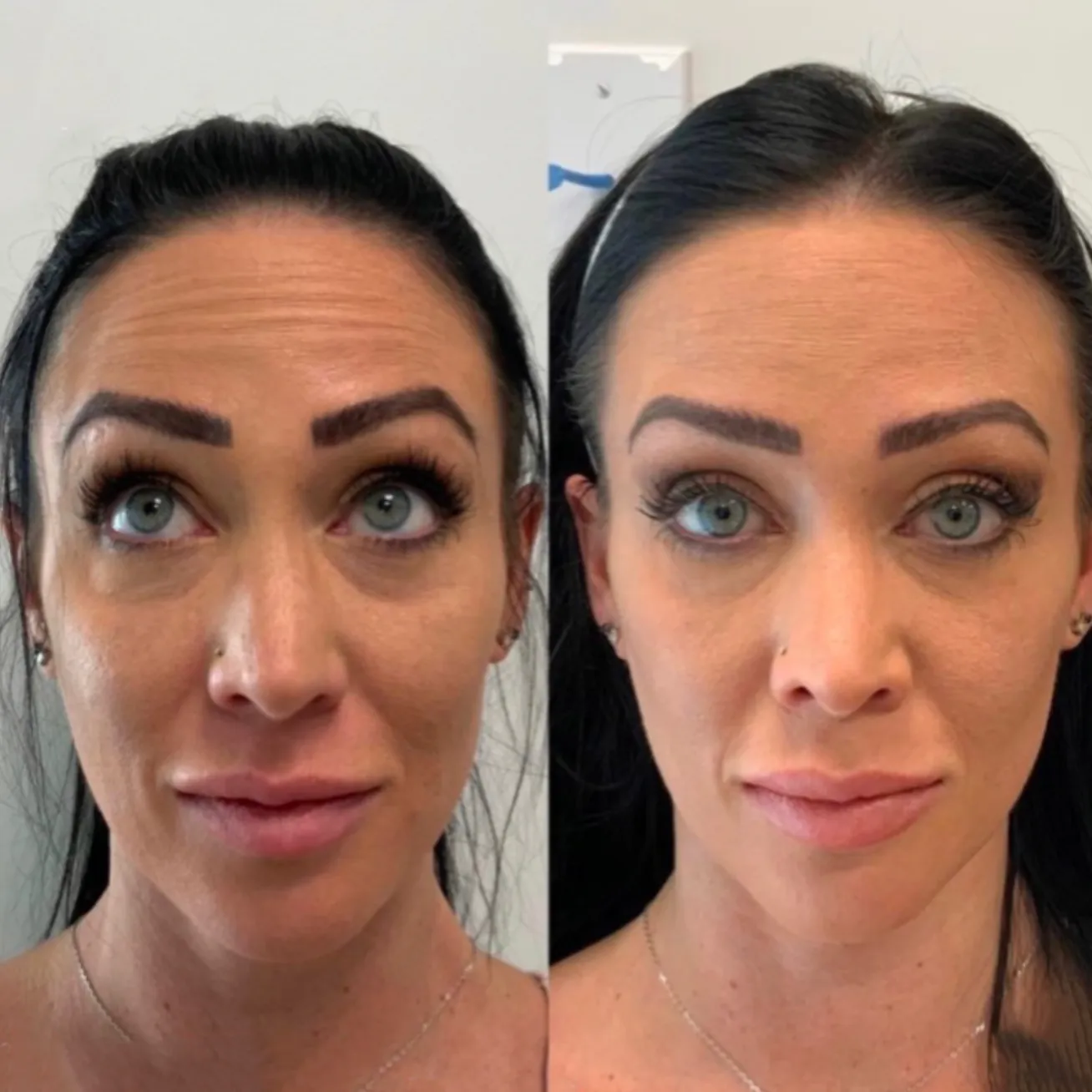 Botox before and after results 4