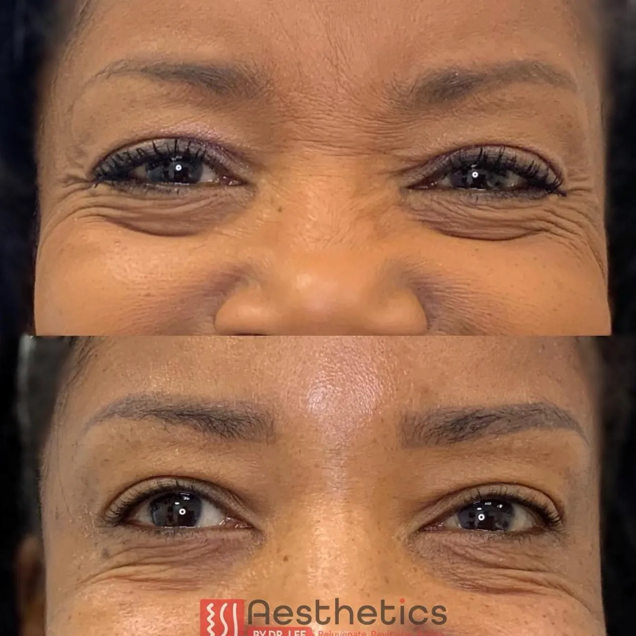 Botox before and after results 5