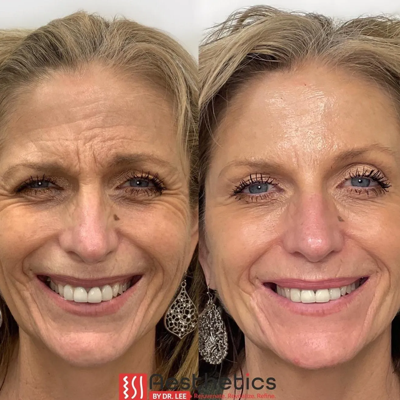 Botox before and after results 6